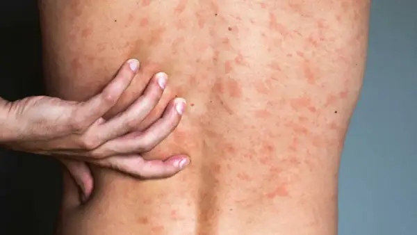 Une main gratte le dos couvert de plaques rouges, signe d'urticaire après la douche.