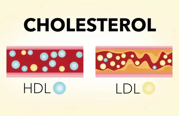 Jak obniżyć cholesterol przy izoteku i uniknąć zdrowotnych zagrożeń