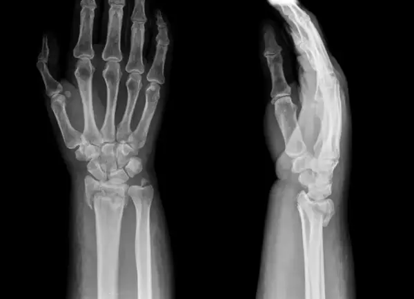 Radiographies du poignet montrant une fracture. L'image de gauche est de face, celle de droite de profil.