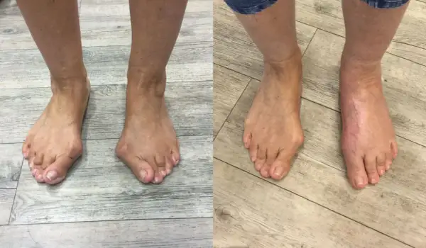 Vorher-Nachher-Vergleich von Füßen mit Hallux valgus, rechts nach Lapidus Arthrodese.