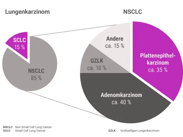 Diagramm zeigt Lungenkrebs-Arten: NSCLC (85%) und SCLC (15%). NSCLC unterteilt in Adenokarzinom (40%), Plattenepithelkarzinom (35%), GZLK (10%) und Andere (15%). Hoffnungsvolle lungenkrebs geheilt erfahrungsberichte sind hier relevant.