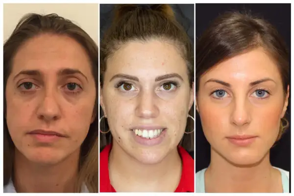 Tre volti di donna mostrano una grave asimmetria facciale prima e dopo un trattamento estetico.