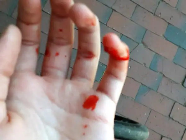 Blutige Hand mit einem offensichtlich gebrochenen Finger. Kleine Schnitte und Blutstropfen auf der Handfläche und den Fingern.