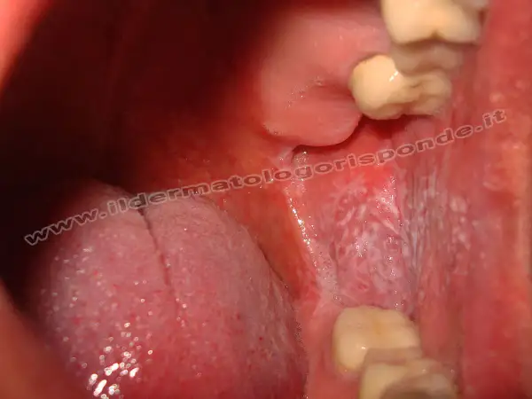 Lesione reticolare bianca sulla mucosa orale, tipica del lichen planus.
