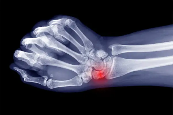 Röntgenbild einer Hand mit hervorgehobenem, entzündetem os triquetrum.