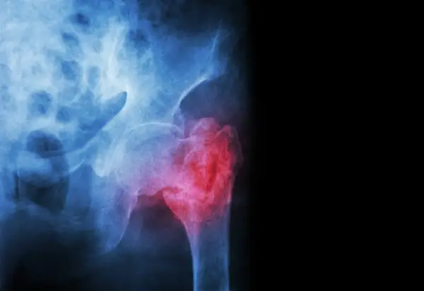 Radiographie du bassin montrant une fracture du col du fémur, marquée en rouge pour indiquer la douleur et la lésion.