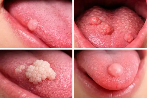 Varie protuberanze in fondo alla lingua, alcune singole e arrotondate, altre più grandi e a grappolo, mostrano diverse condizioni della lingua.