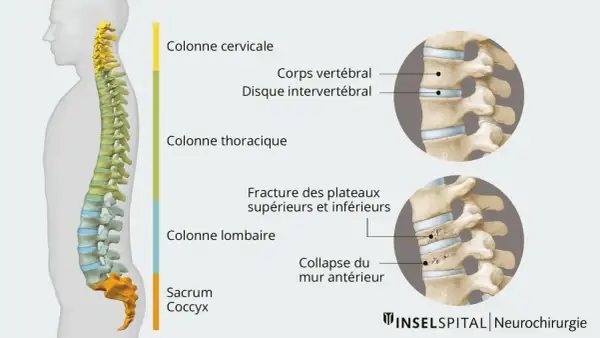 Illustration montrant une fracture vertèbre lombaire. Le temps de guérison dépend de la gravité de la lésion.