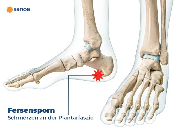 Anatomische Darstellung eines Fußes mit Hervorhebung eines Fersensporns, der Schmerzen an der Plantarfaszie verursacht. Liebscher & Bracht Fersensporn-Behandlung.