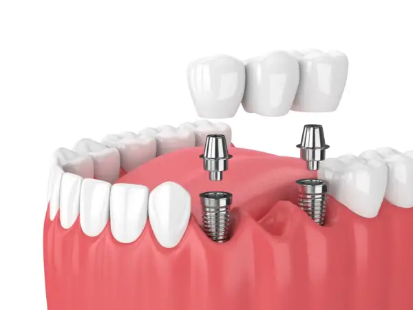 Model szczęki z widocznymi implantami zębowymi i mostem protetycznym. Implant zęba to nowoczesne rozwiązanie.