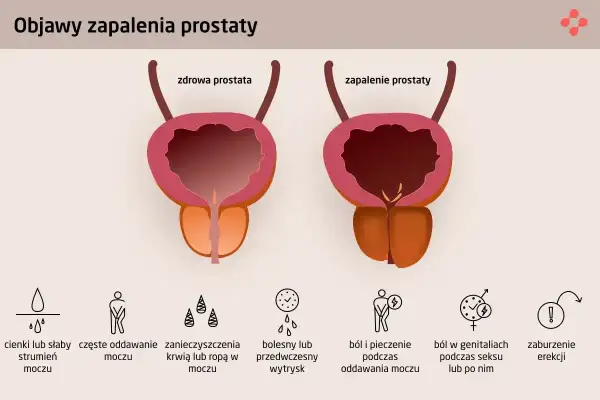 Ilustracja porównuje zdrową prostatę z zapaloną, pokazując objawy zapalenia prostaty: problemy z oddawaniem moczu, ból, pieczenie i zaburzenia erekcji.