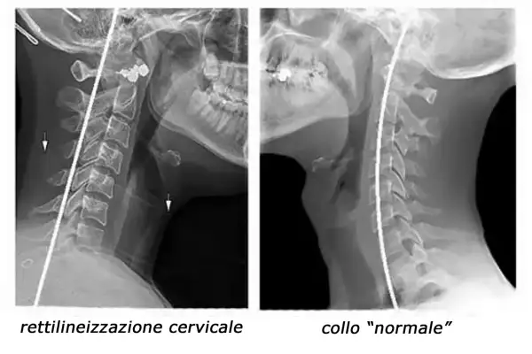 Radiografie del rachide cervicale: a sinistra, rettilineizzazione cervicale con frecce che indicano anomalie; a destra, collo "normale".