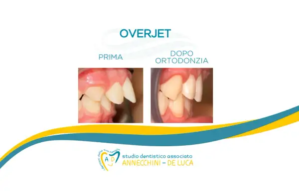 Prima e dopo ortodonzia: denti castoro corretti. Studio dentistico Annecchini - De Luca.