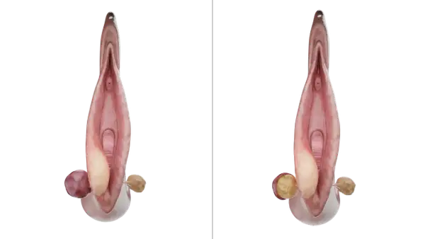 Anatomie féminine montrant une glande de Bartholin enflammée, illustration pour le bartholinite traitement.