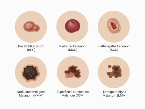 Sechs Hautkrebsarten: Basalzellkarzinom, Merkelzellkarzinom, Plattenepithelkarzinom, noduläres malignes Melanom (NMM), superfiziell spreitendes Melanom (SSM) und Lentigo-maligna-Melanom (LMM). Die Prognose für Melanom Stadium 1 ist gut.
