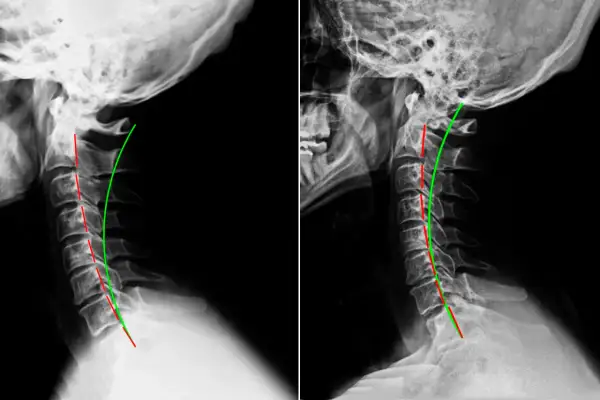 Radiografie cervicali che mostrano una lordosi cervicale ridotta, potenziale causa di vertigini.