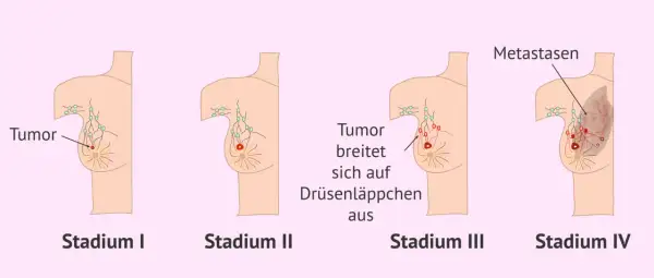 Illustrationen zeigen Stadien von Brustkrebs. Von Stadium I bis IV wächst der Tumor, befällt Lymphknoten und bildet Metastasen. Brustkrebs G3 Erfahrungen sind oft mit fortgeschrittenen Stadien verbunden.