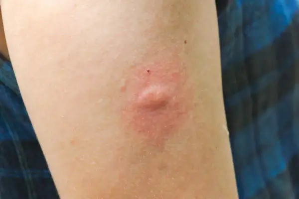 Brazo con una picadura hinchada y dura, rodeada de enrojecimiento.