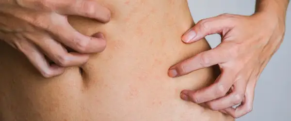Zaburzenia hormonalne objawy skórne: co może oznaczać Twoja skóra?