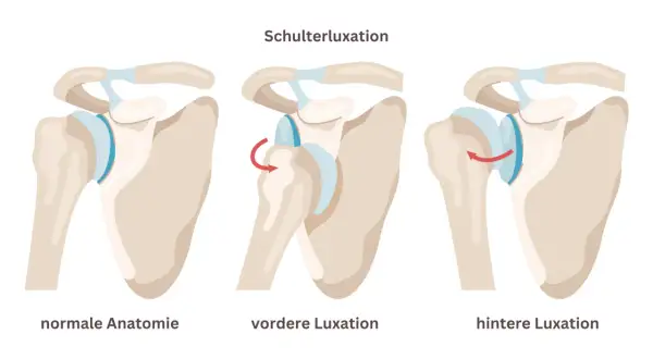 Schulterluxation: normale Anatomie, vordere Luxation (Rotationspfeil) und hintere Luxation (Rotationspfeil). Eine latarjet op kann bei wiederholten Luxationen helfen.