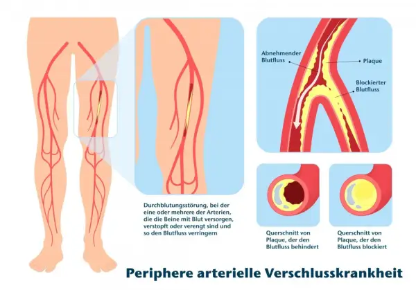 Illustration zeigt PAVK: Plaque verengt Arterien im Bein, behindert Blutfluss. Gehtraining kann helfen.
