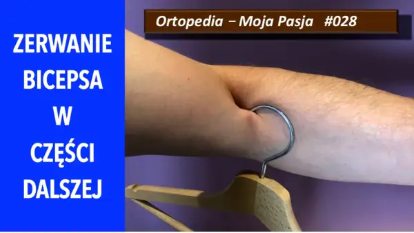 Zerwanie bicepsa w części dalszej. Widoczny hak wbit w mięsień, symbolizujący uraz.