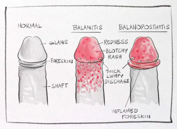 Ilustracja porównuje normalnego penisa z balanitis i balanoposthitis, pokazując objawy takie jak zaczerwienienie i wydzielina. Zrozumienie, smegma co to, jest kluczowe dla higieny.
