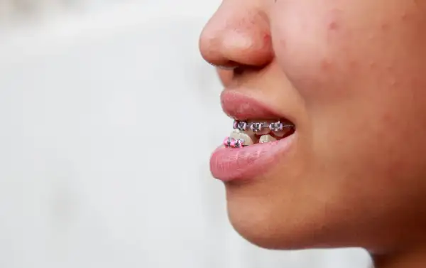Primo piano di una bocca con apparecchio ortodontico, la **mandibola in avanti** per mostrare i denti allineati.