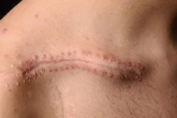 Cicatrice chirurgicale avec des points rouges, comme un fil résorbable qui ne se résorbe pas, sur une peau claire.