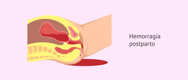 Ilustración anatómica que muestra los tipos de sangrado postparto, con sangre saliendo del útero y la vagina.