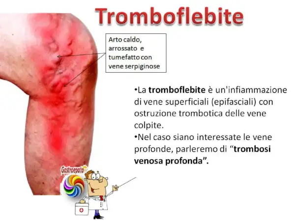 Gamba con arrossamento e vene gonfie, indicativo di un calore improvviso alle gambe.