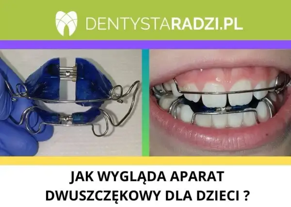 Aparat ortodontyczny z NFZ: Tylko dla dzieci? Prawda o refundacji