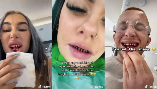 Trzy osoby pokazują swoje zęby po zabiegu stomatologicznym w Turcji. Jedna z nich trzyma chusteczkę, druga ma napis "Braved the shave".