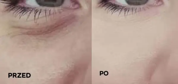Przed i po: jak dbać o skórę pod oczami, by była gładka i wypoczęta. Widoczne wygładzenie zmarszczek.