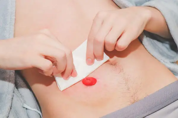 Osoba delikatnie czyści skórę wokół stomii pełnej, przygotowując ją do zmiany opatrunku.