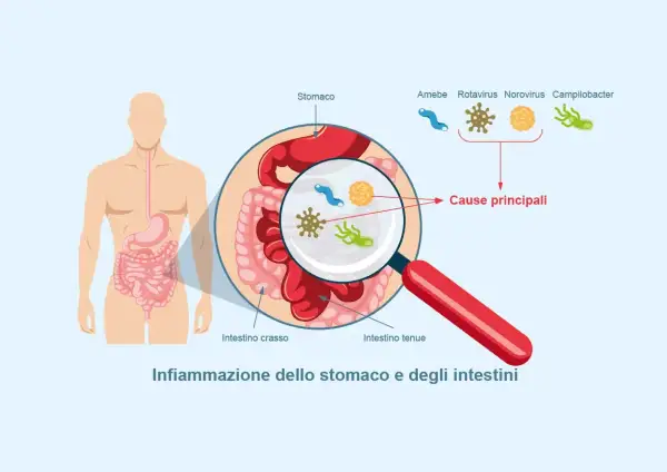 Illustrazione dell'apparato digerente con ingrandimento che mostra i microrganismi causa di gastroenterite sintomi.