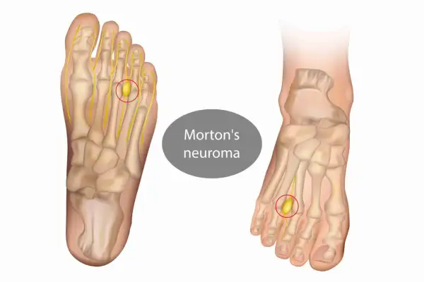 Illustrazione anatomica del piede che mostra un neuroma di Morton, una condizione che rende doloroso il camminare.