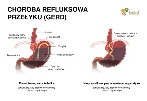Ilustracja pokazuje prawidłowe i nieprawidłowe działanie zwieracza przełyku, wyjaśniając problem refluksu żołądka.