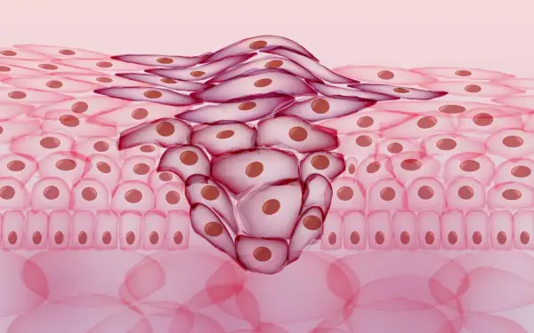 Abnormal cell growth, a concerning histologischer befund, shows invasive cells spreading through tissue layers.