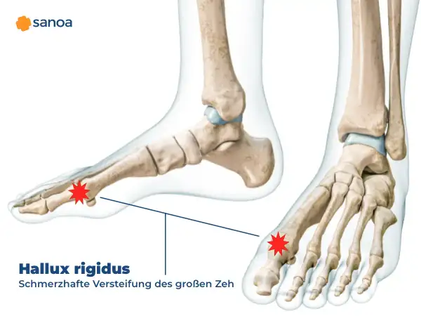 Anatomische Darstellung des Fußskeletts mit Hervorhebung des Gelenks am großen Zeh, das von Hallux rigidus betroffen ist.