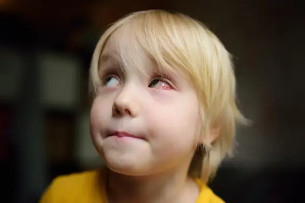 Mały chłopiec z blond włosami ma spuchnięte, zaczerwienione oko.