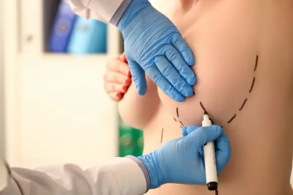 Chirurg zaznacza markerem piersi do operacji. Jedna pierś jest większa od drugiej po operacji.