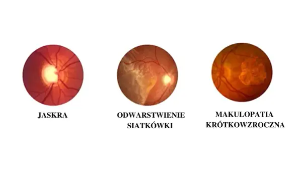 Trzy obrazy dna oka: jaskra, odwarstwienie siatkówki i makulopatia krótkowzroczna.