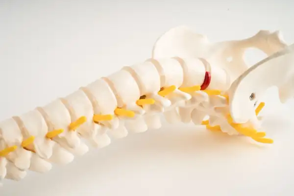 Model kręgosłupa z zaznaczonym naczyniakiem. Ostrożność przy pracy fizycznej jest kluczowa, by nie pogorszyć stanu.
