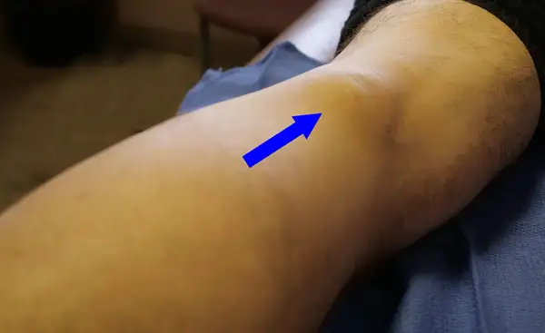 Ginocchio con freccia blu che indica un'area gonfia, possibile muscolo popliteo infiammato. Esercizi per il recupero.