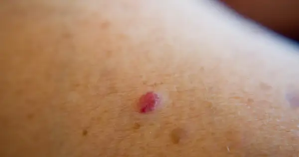 Mały, czerwony naczyniak wiśniowy na skórze, otoczony drobnymi włoskami i innymi zmianami skórnymi.