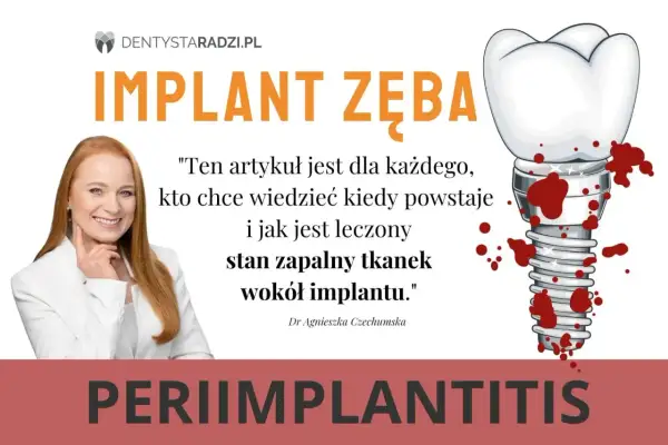 Dowiedz się, jak wyleczyć stan zapalny tkanek wokół implantu zęba. Grafika przedstawia implant zęba z krwią i uśmiechniętą dentystkę.