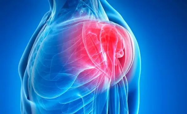 Anatomical illustration of a shoulder with inflamed bursa highlighted in red.