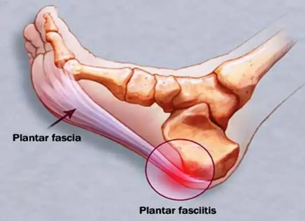 Illustration av fotens anatomi som visar plantar fascia och smärtsamma triggerpunkter vid plantar fasciitis.