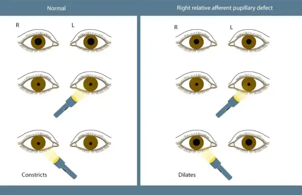 Ilustracja porównuje reakcję źrenic w oku normalnym i z prawostronnym deficytem aferentnym. Widoczna anizokoria, czyli nierówność źrenic, jest kluczowa w diagnostyce.
